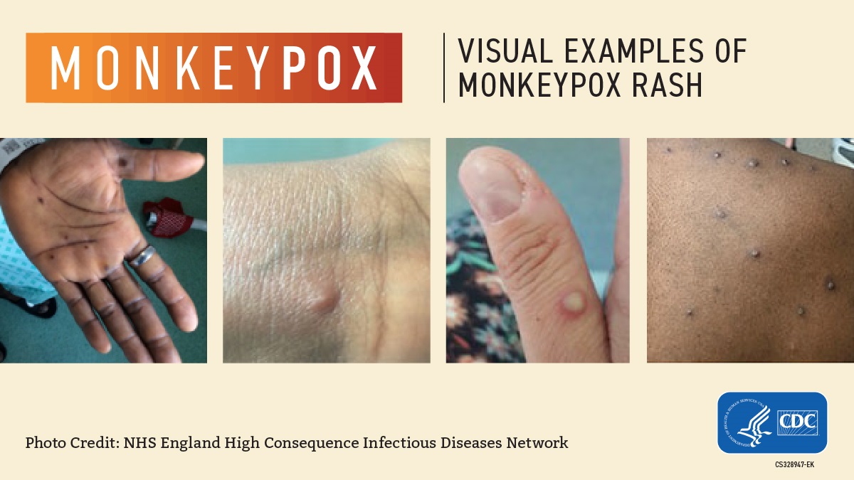 Rash similar to pimples or blisters on hands, face, and feet
